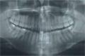 A fogászaton alkalmazott röntgen árthat a szívünknek