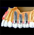 Az implantáció szerepe a fogászatokon